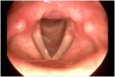 throat cancer does voice normal adele vocal box cords smoker color healthy lesions