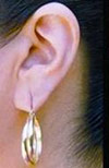 Thumbnail image for Torn Ear Lobe