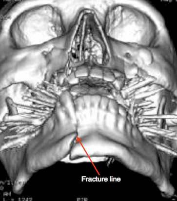 Figure 1: CT 3D reconstruction of the head depicting a mandibular fracture with evident misalignment of the overlying teeth.