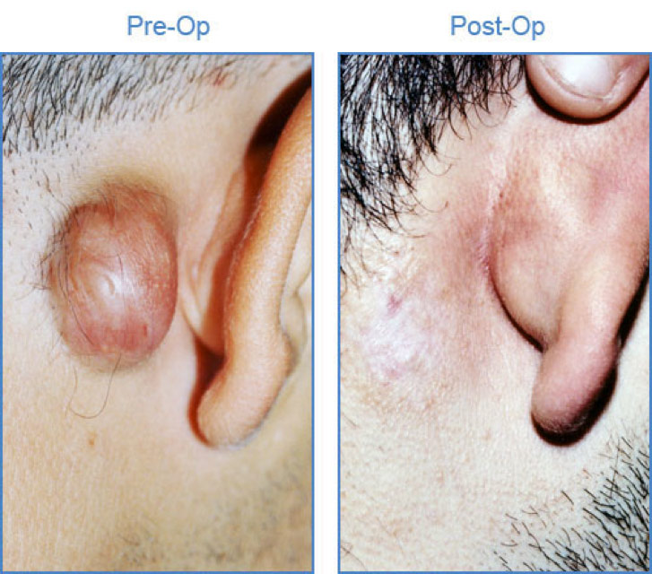 Figure 1. Keloid lesion behind the right ear before and after cryotherapy treatment. Notice regression of the keloid after one treatment. (Courtesy of Drs. Yaron Har-Shai, Z.Paul Lorenc, cyroshape.com)