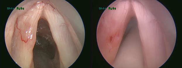 Figure 1: Varices before laser treatment (left). Varices after treatment. Note that the pink hue of the photo is due to a lens filter that protects the surgeon’s eyes from the laser (right).