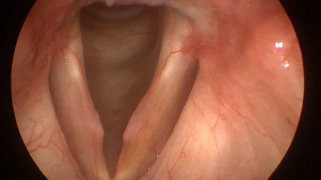Figure 2: Stroboscopy image of the vocal cords and larynx demonstrating erythematous vocal cord nodules.