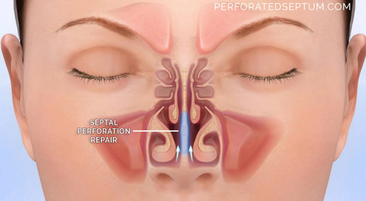 Figure 5. Septal perforation repair showing restoration of normal airflow. It is important to seek treatment before the perforation gets so large as to cause a saddle nose. Treatment is complex and should be done only by a surgeon with extensive experience in nasal reconstruction.