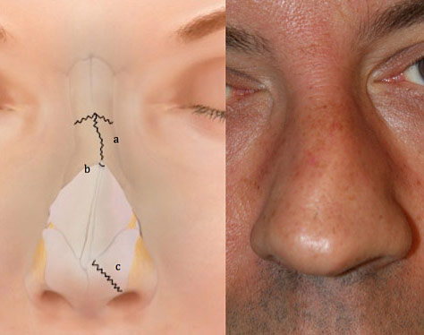 Figure 2: Nasal fractures can typically include damage to or displacement of the nasal septum.