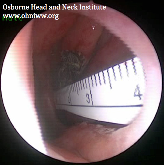Figure 2: Nasal septum perforation. A ruler has been inserted into the opposite nostril to demonstrate scale.