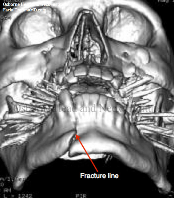 Figure 2: A CT scan of a jaw fracture in the parasymphysis area of the mandible is shown.