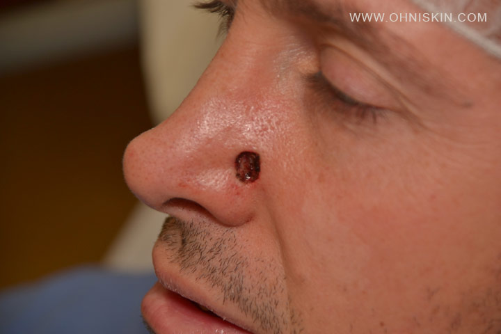 Basal Cell Carcinoma ( Nose ) Picture - MedicineNet