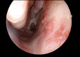 Thumbnail image for Hereditary Hemorrhagic Telangiectasia