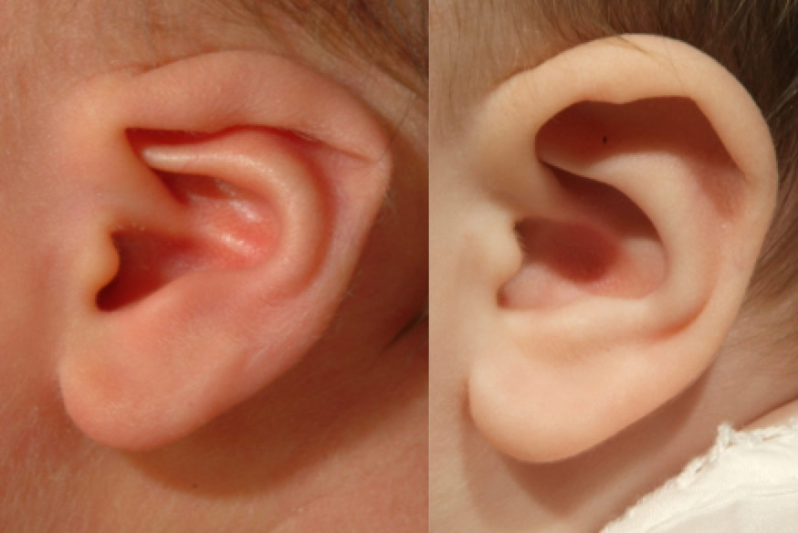 newborn folded ear treatment