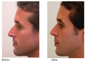 Read more about the article Rhinoplasty Tips: Male Rhinoplasty