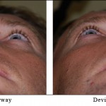 Deviated Septum: Facts & Information