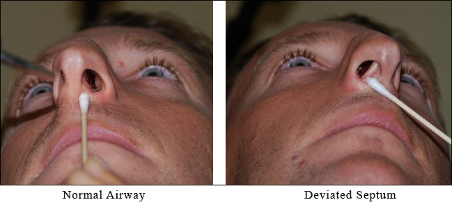 Deviated Septum Surgery Los Angeles Ear Nose Throat Doctors