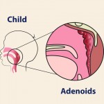 Adenoids: Frequently Asked Questions