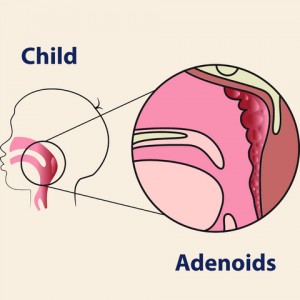Read more about the article Adenoids: Frequently Asked Questions