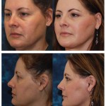 The Facelift Procedure & Facial Rejuvenation