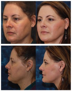 Read more about the article The Facelift Procedure & Facial Rejuvenation