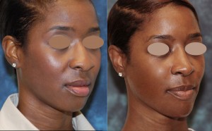 Read more about the article African American Female Rhinoplasty