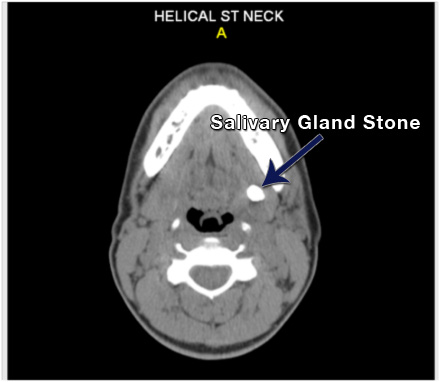 Diagnosing a salivary gland stone