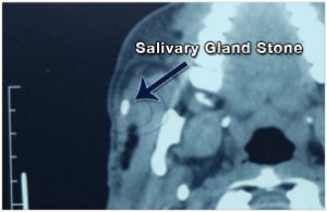 Read more about the article Salivary Gland Stones Treatment Options