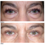 Your Skin, Your Image: The “Eyelid-Lift” Procedure (Blepharoplasty)