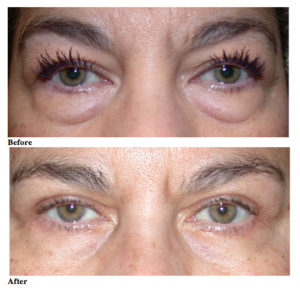 Read more about the article How to Treat Under-Eye Bags