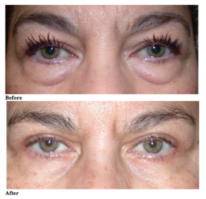 Read more about the article Your Skin, Your Image: The “Eyelid-Lift” Procedure (Blepharoplasty)