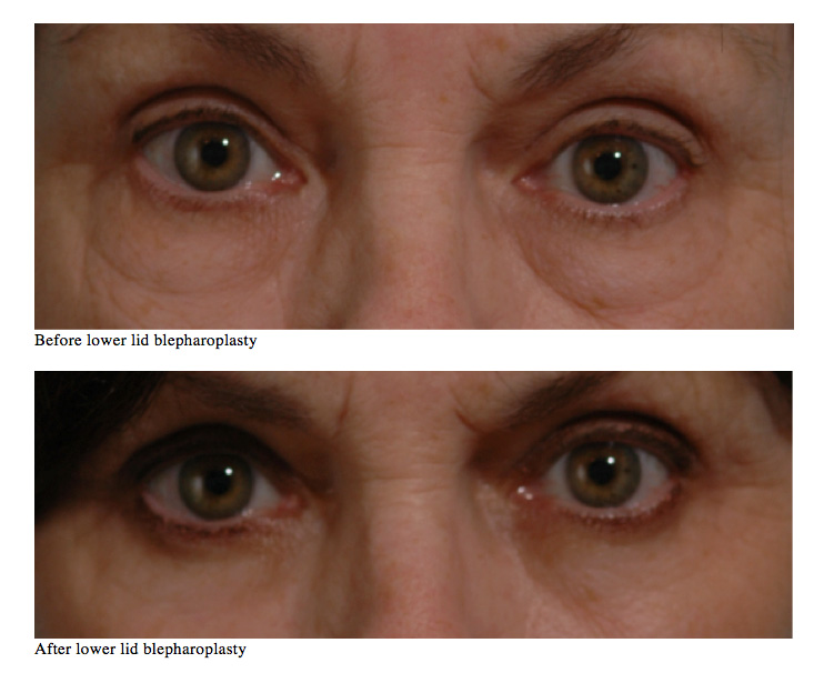 Blepharoplasty Before & After