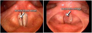 Read more about the article The Effects of Aspirin (NSAIDs) on the Voice