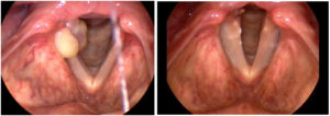 Read more about the article Treatment of Granuloma