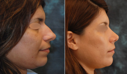 hispanic nose surgery