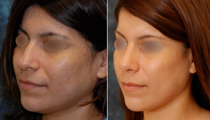 hispanic rhinoplasty