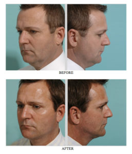 Read more about the article The Male Facelift Procedure