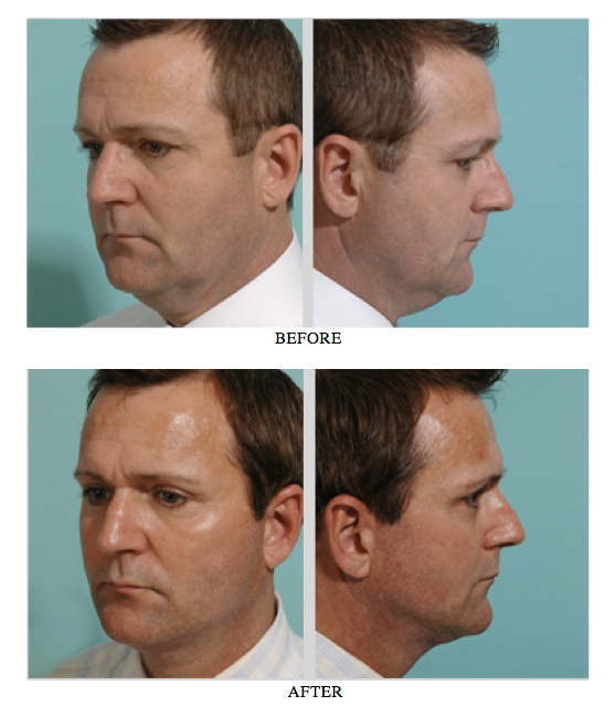 Male Facelift Before and After