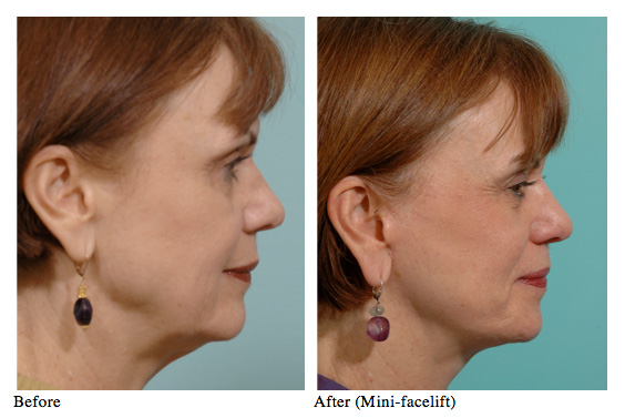 Mini Facelift Procedure