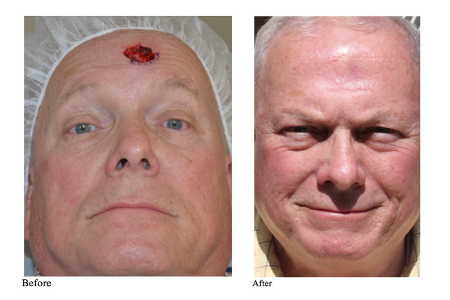 Mohs Surgery Before and After