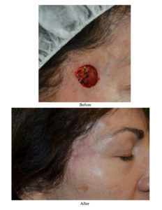 Read more about the article Scarring After Mohs Surgery