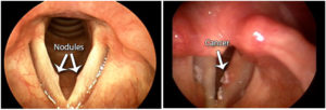 Read more about the article Diagnosis of Vocal Nodules
