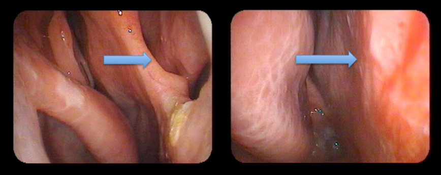 Septal Perforation Repair Surgery