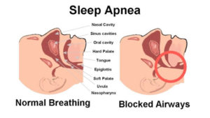 Read more about the article What is Obstructive Sleep Apnea (OSA)?