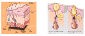 Read more about the article Should You Take Accutane?