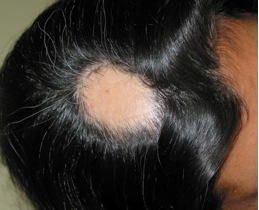 alopecia areata