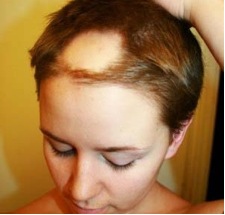 alopecia areata