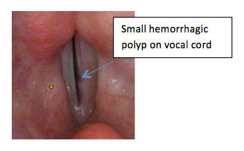 marijuana vocal cords