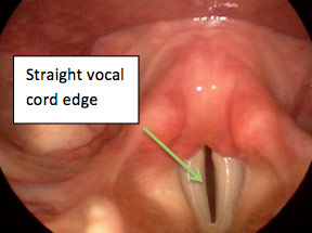 hoarse voice