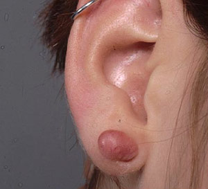 Swollen ear lobe after piercing sales