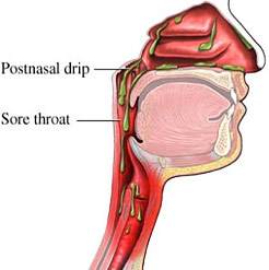 nasal irrigation singers