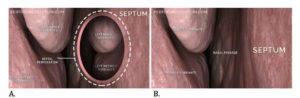 Read more about the article Septal Perforation– Treatment of Complications
