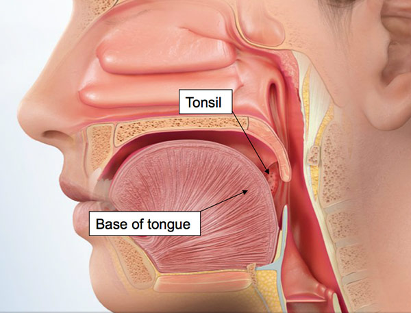 papillomas in throat symptoms