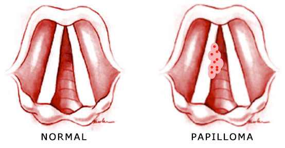 papilloma back of throat