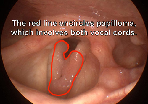 what causes papillomas in the throat